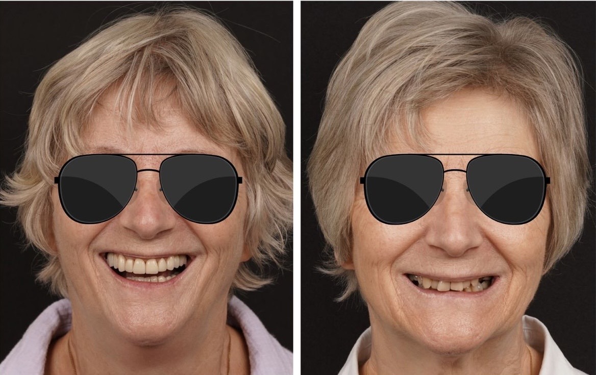 Voorbeeld van esthetisch resultaat met keramische facings, patiëntcase 1